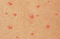 Public Health Department Confirms Six Cases of Chickenpox