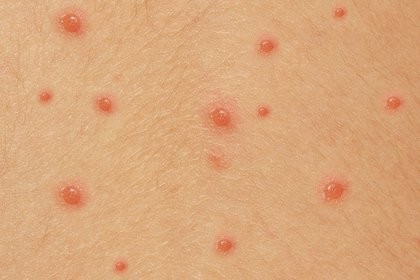 Public Health Department Confirms Six Cases of Chickenpox